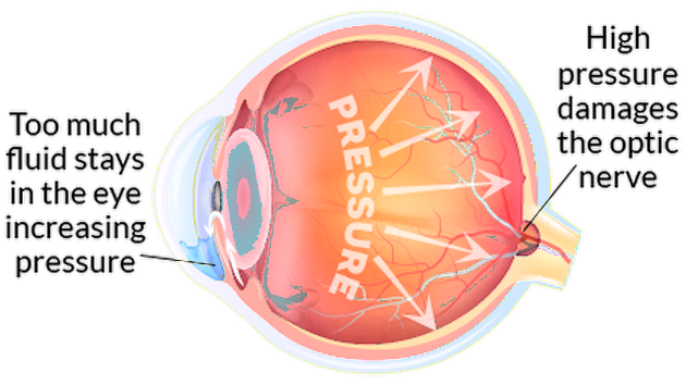 Eye Pressure / Intraocular pressure (IOP)