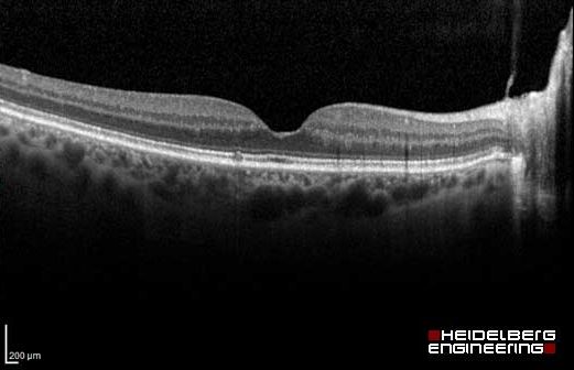 Optical Coherence Tomography (OCT)